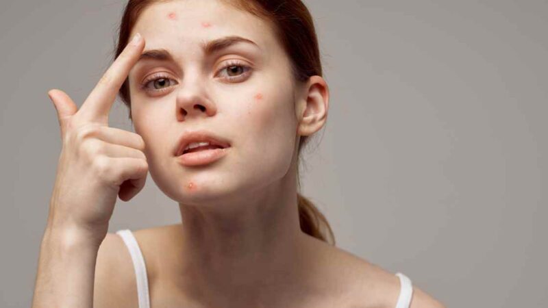 Acne-Prone Skin Care Routine