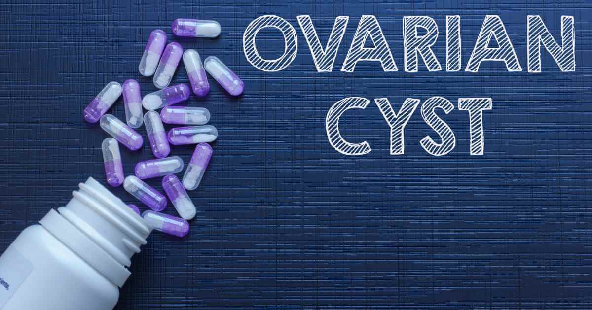 Different Types of Ovarian Cysts and Treatment Options